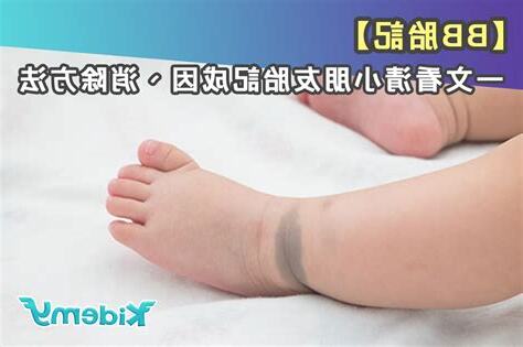 胎記 成因